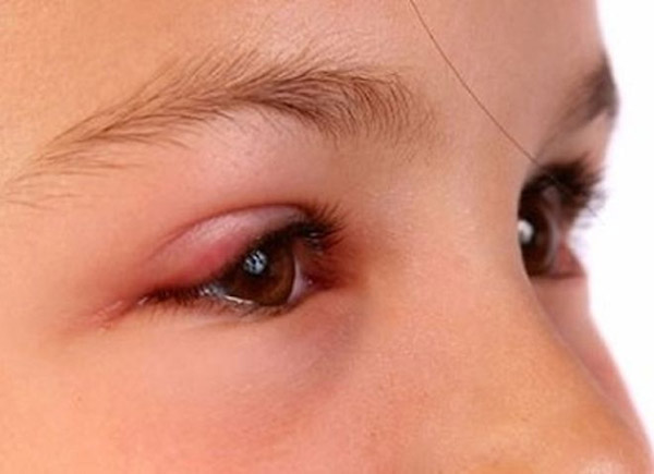 Trẻ bị nhiễm Adenovirus có thể bị viêm kết mạc mắt